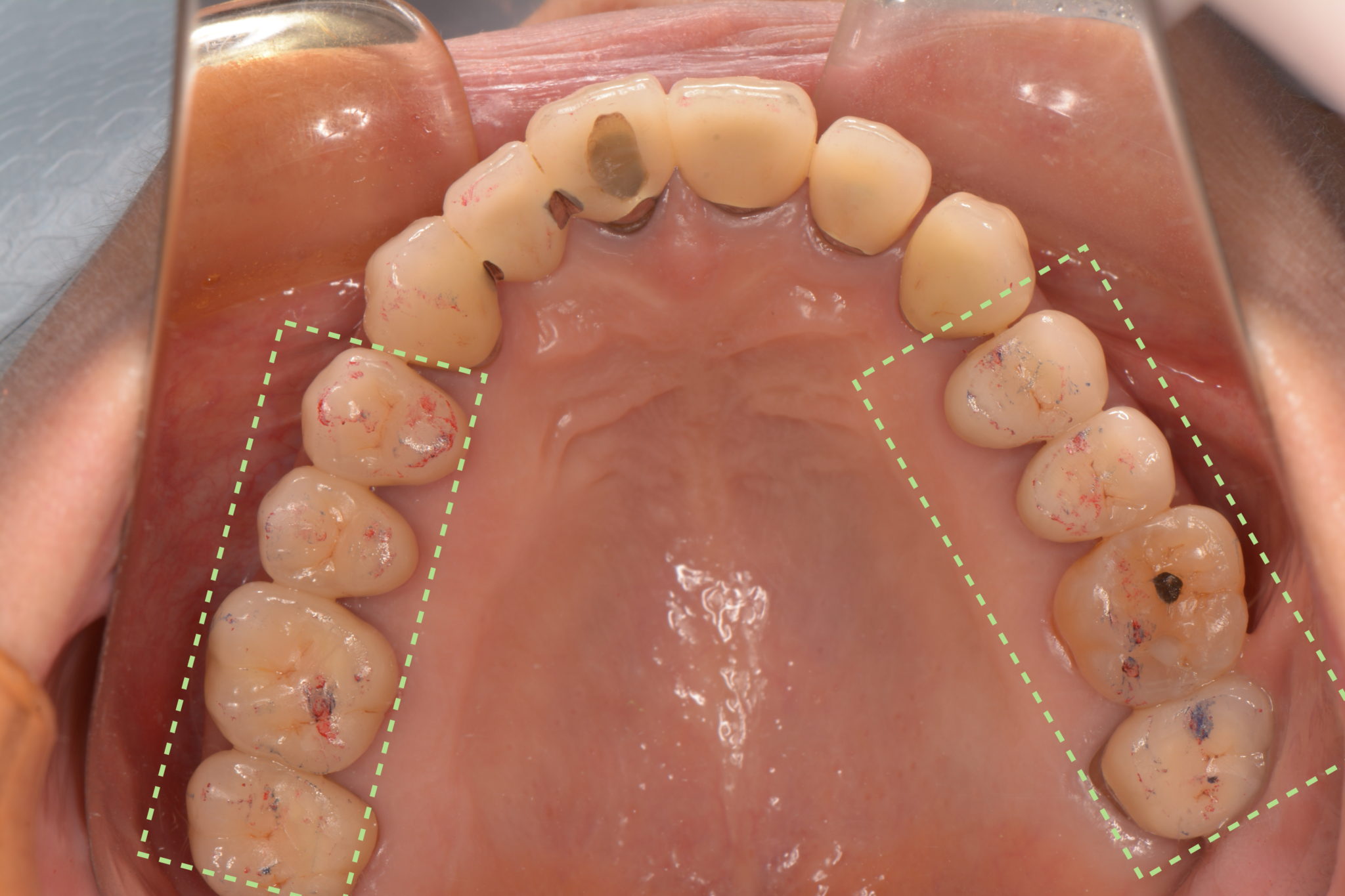 噛み合わせの調整 神戸三宮の歯医者 精密な虫歯治療や審美歯科なら高田歯科